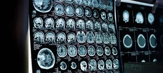 重点推荐！黄冈治疗癫痫病专科医院哪家好-中老年突然患癫痫病是什么原因？