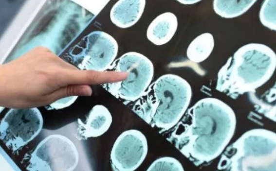 热点速看！襄阳治疗癫痫病效果好的医院-癫痫患者如何做能减少发作次数？