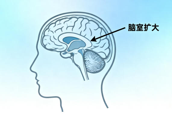 湖北治癫痫病中际医院抗癫专科-孩子为什么会得儿童失神癫痫？