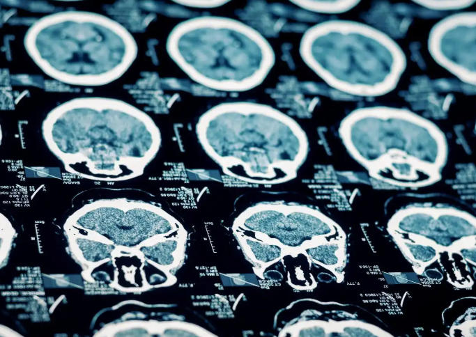 警惕！ 4大脑区癫痫发作各不同，别再错当成睡眠问题！