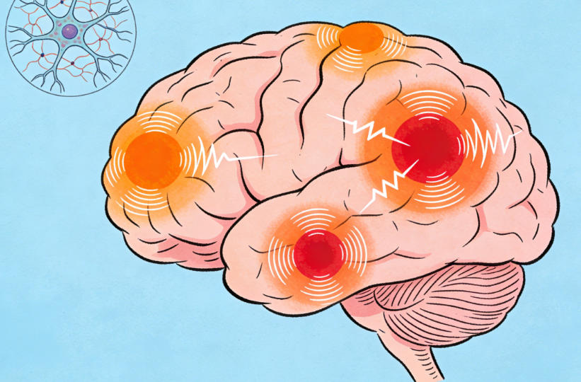 警惕！头部受伤后，这种“隐形后遗症”—外伤性癫痫易被忽视！