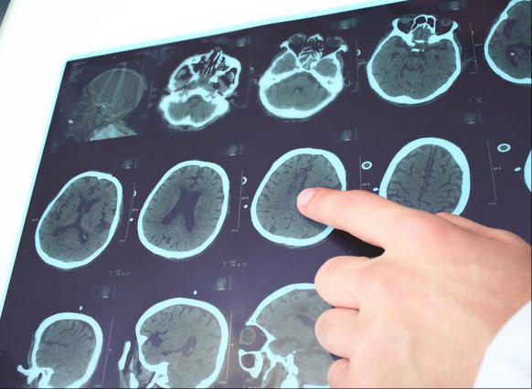 明明检查正常，为何还会确诊癫痫？医生揭秘关键原因