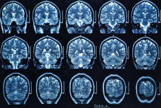 脑部损伤、感染、遗传，盘点癫痫三大主要诱因，早知道早预防