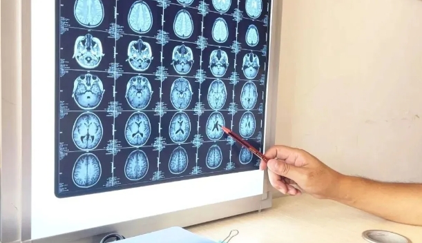 癫痫久治不见好？多半是漏掉了这项关键神经影像检查